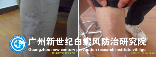 宋同学 14岁 右小腿白斑7余年