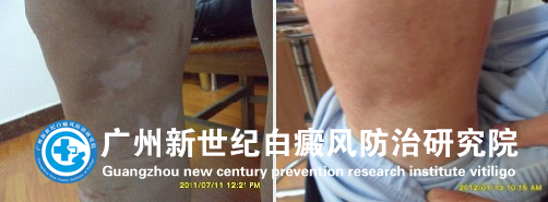 宋同学 14岁 右小腿白斑7余年