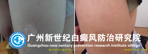 宋同学 14岁 右小腿白斑7余年